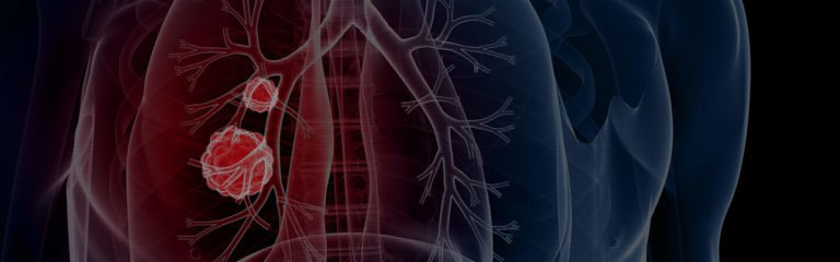 ‘EarlyCDT Lung Test’ a Ray of Hope for Lung Cancer Early Diagnosis
